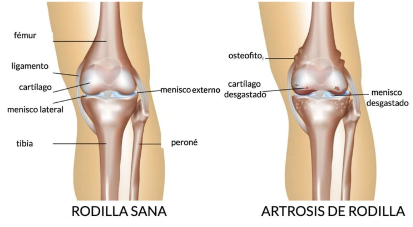 Artrosis de rodilla, Síntomas, tratamiento y diagnóstico