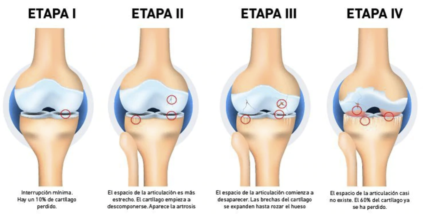 Qué es la artrosis de rodilla? Síntomas y tratamientos
